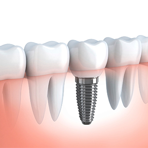 Implantes