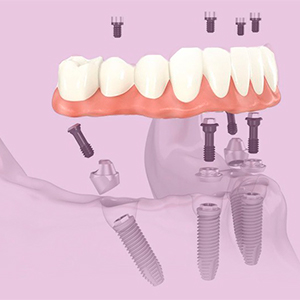 Overdenture